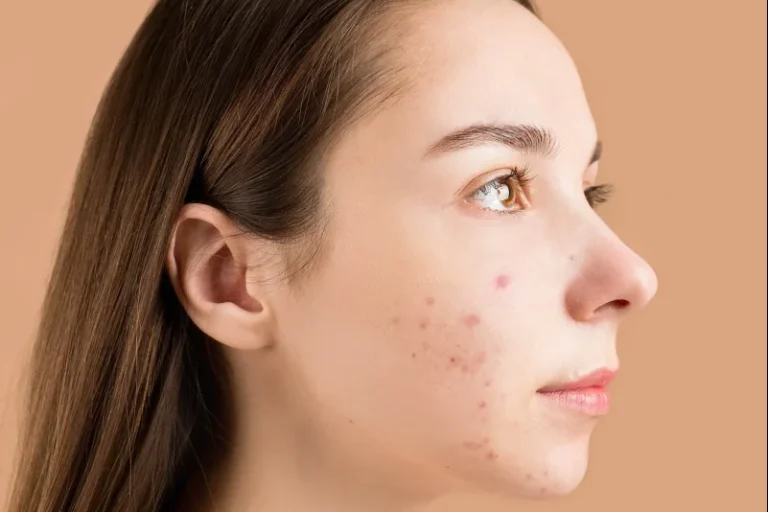 natural remedies to treat acne