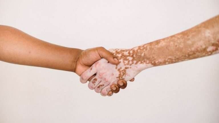 coping with vitiligo