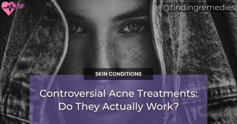 Controversial Acne Treatments: Do They Actually Work?