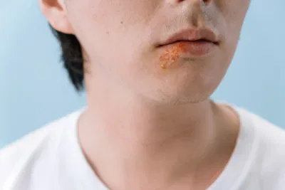 know about eczema