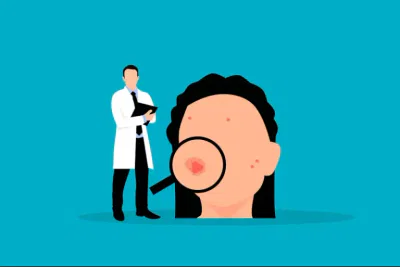 autoimmune disease causing hives