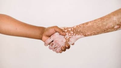 coping with vitiligo