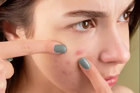 lifestyle changes to deal with acne scaled e1651270398530