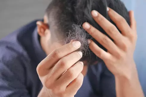 Autoimmune Hair Loss