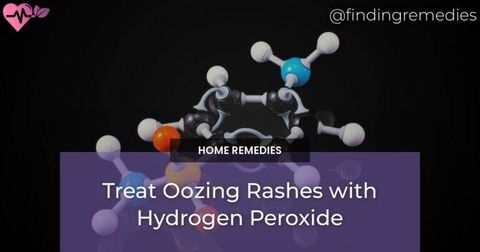 Treat Oozing Rashes with Hydrogen Peroxide